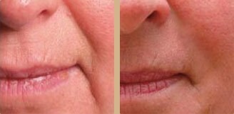 Salon Urody Marzeny Gross - Mezoterapia cz. 2