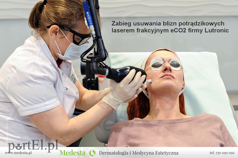 Kompleksowa terapia blizn i rozstępów w Klinice Medesta