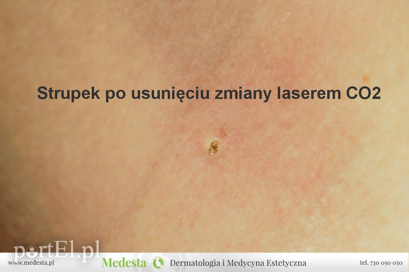 Laserowe usuwanie zmian okolic intymnych (brodawki, polipy, kłykciny)