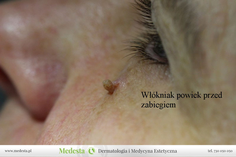 Rzeczywiste rezultaty zabiegów w Klinice Medesta